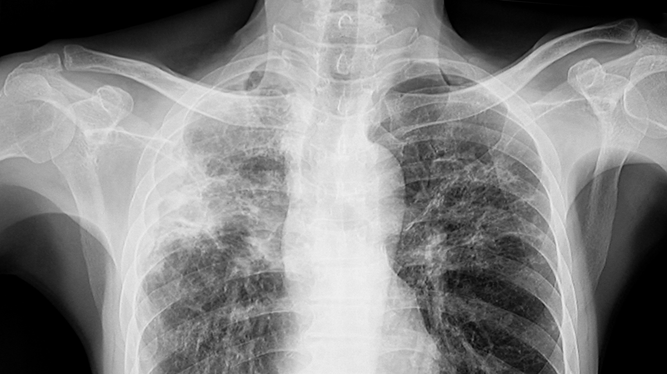 Chest xray of the patient with lungs tuberculosis showing reticulonodular opacity involve both lungs from granulomatous TB infection.